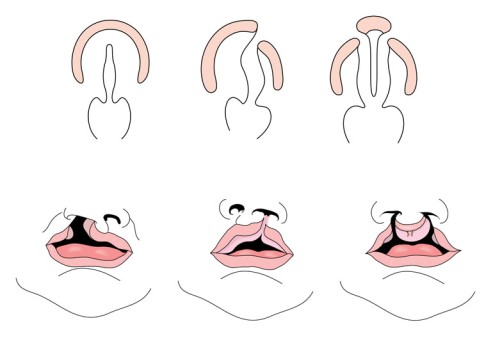 Cleft Lip Surgery by OrangeCountySurgeons